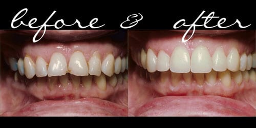 define tetracycline stain in dentistry