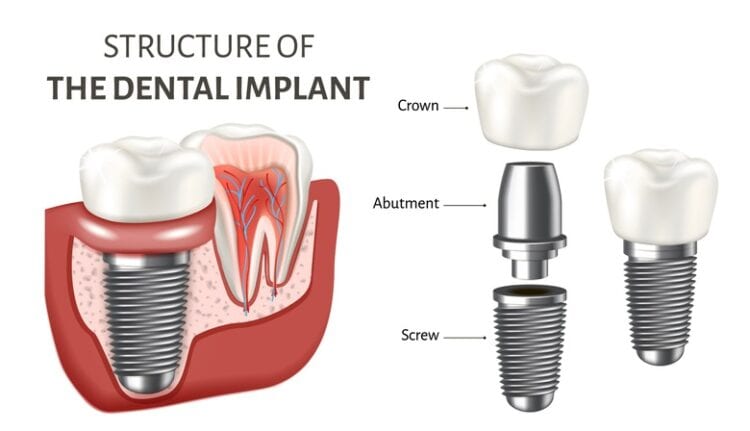 dental implant diagram