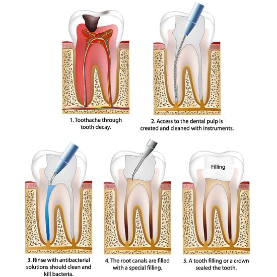 Root Canal Treatment in Lubbock Thousands of Satisfied Patients