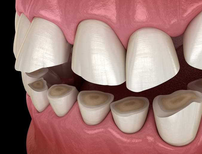 Dental attrition (Bruxism)
