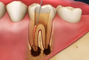 diagram of root canal