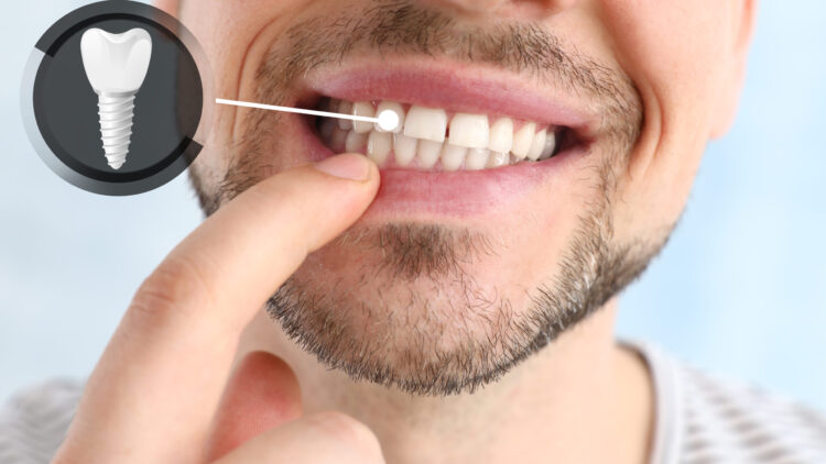 Man showing implanted teeth