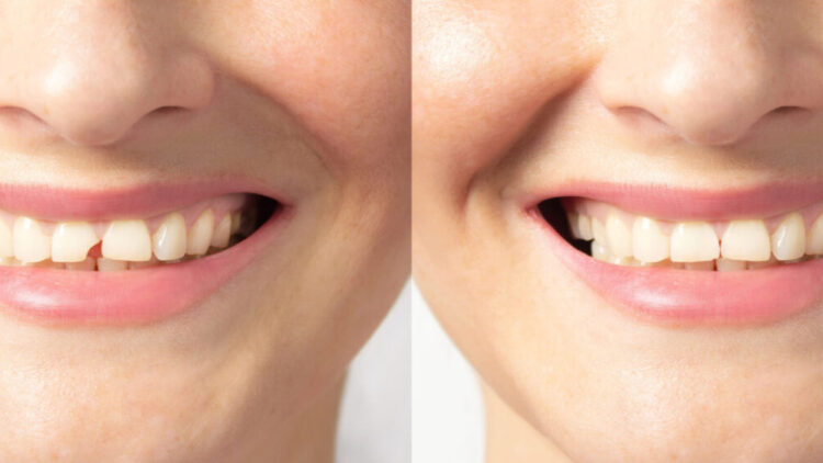 chipped tooth before and after