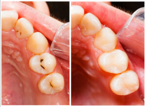 composite filling